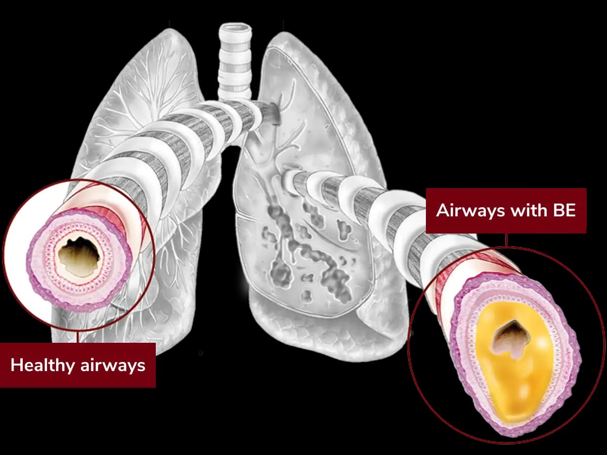 Bronchiectasis (BE) airways are widened and filled with mucus compared to healthy airways