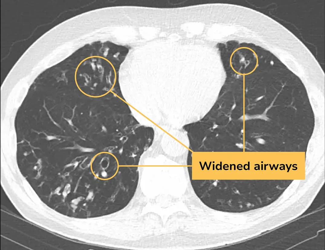 CT scan image of a lung with bronchiectasis (BE)