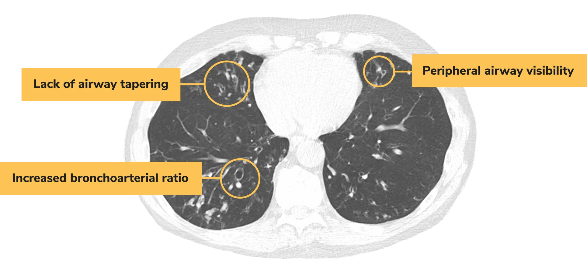 CT scan of lungs showing widened airways caused by bronchiectasis (BE)